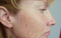 Пигментные пятна на лице: причины появления Какой врач лечит пигментацию на лице